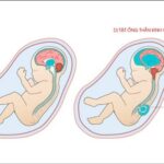 Ngăn ngừa các dị tật ống thần kinh như tật nứt đốt sống