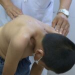 Nguyên nhân và hệ quả của bệnh gù lưng
